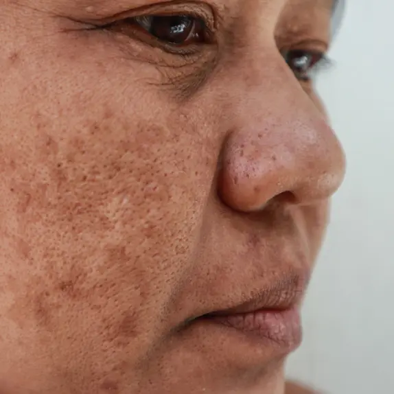 Pigmentation & Skin Concerns